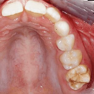 IMG - DENTE COM HMI - 01_v01