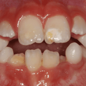 IMG - DENTE COM HMI - 02_v01