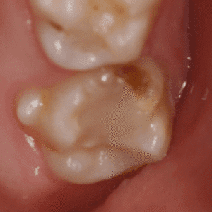 IMG - DENTE COM HMI - 03_v01