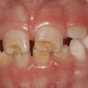 IMG - DENTE COM HMI - 04_v01