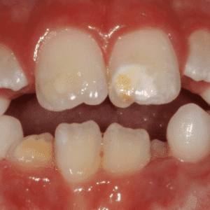 IMG - DENTE COM HMI - 06_v01