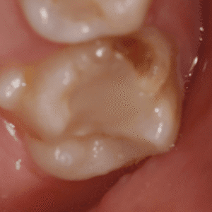 IMG - DENTE COM HMI - 07_v01