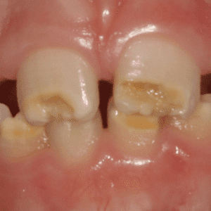 IMG - DENTE COM HMI - 08_v01