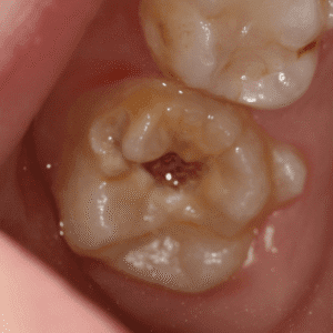 IMG - DENTE COM HMI - 09_v01