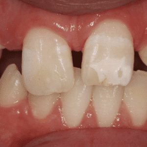 IMG - DENTE COM HMI - 10_v01