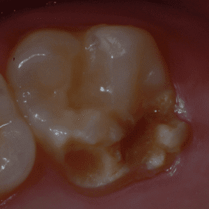 IMG - DENTE COM HMI - 11_v01