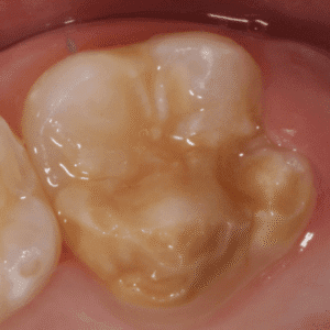 IMG - DENTE COM HMI - 13_v01