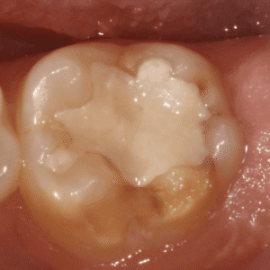 IMG - DENTE COM HMI - 14_v01