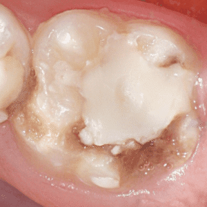 IMG - DENTE COM HMI - 15_v01