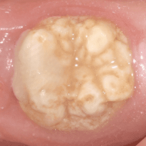 IMG - DENTE COM HMI - 16_v01